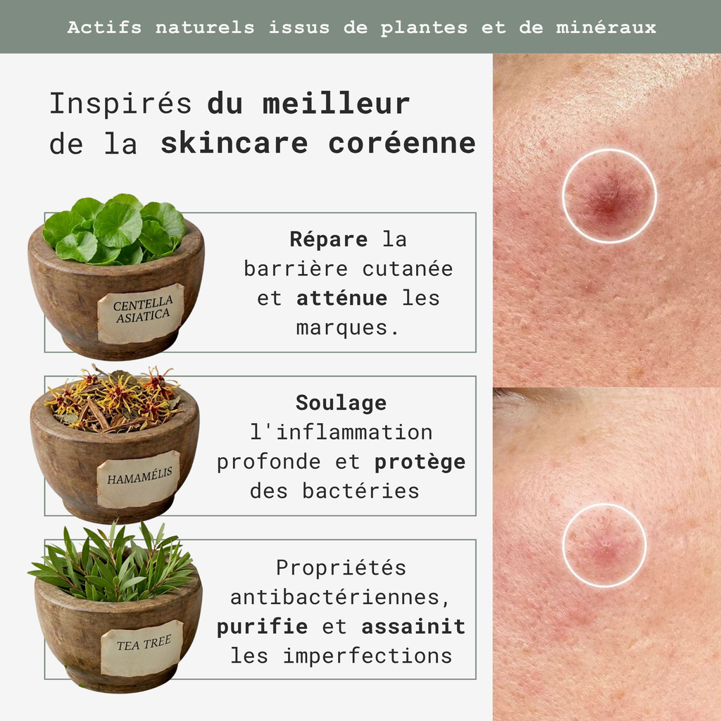 Soin Ciblé Acné Hormonale – Patchs Invisibles