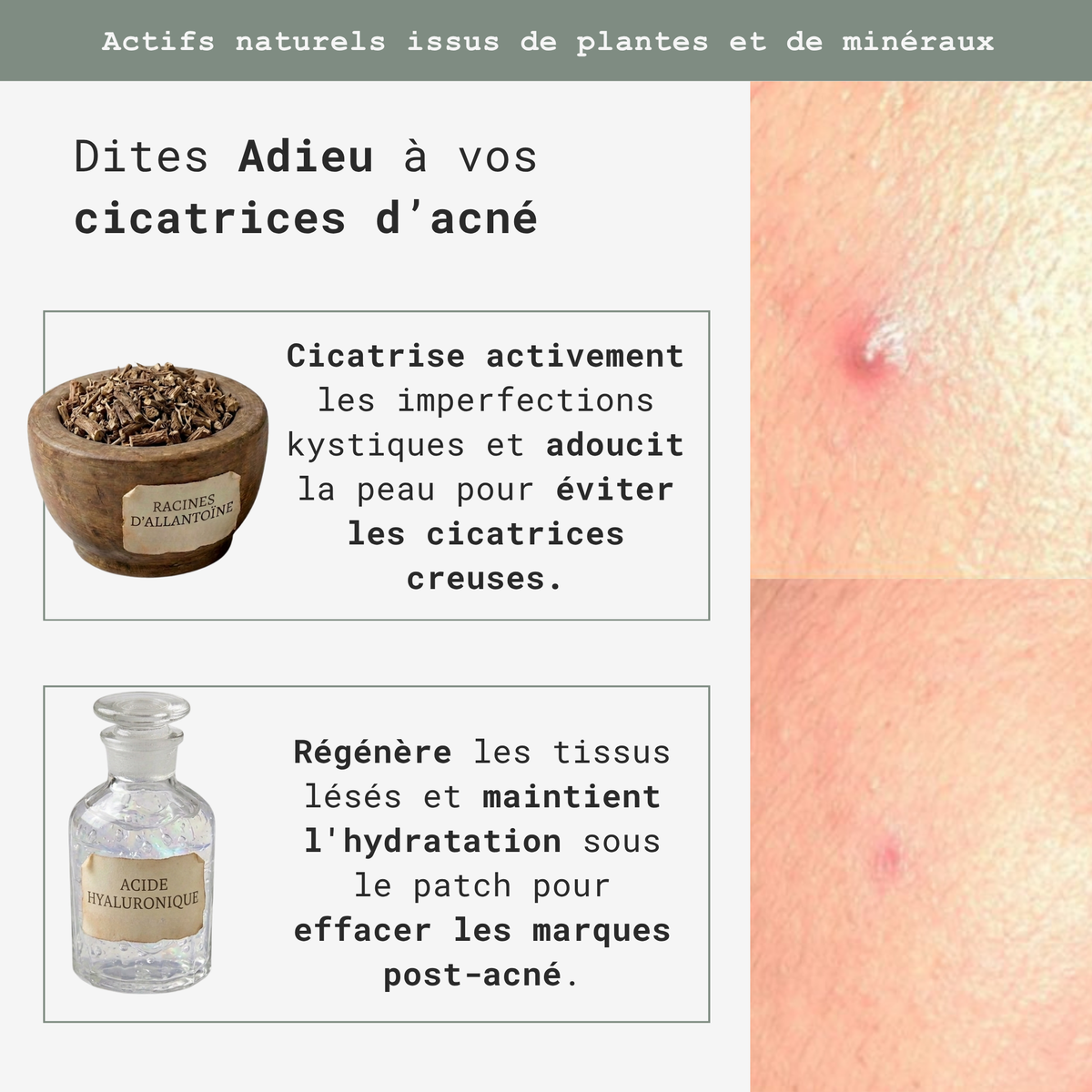 Soin Ciblé Acné Hormonale – Patchs Invisibles