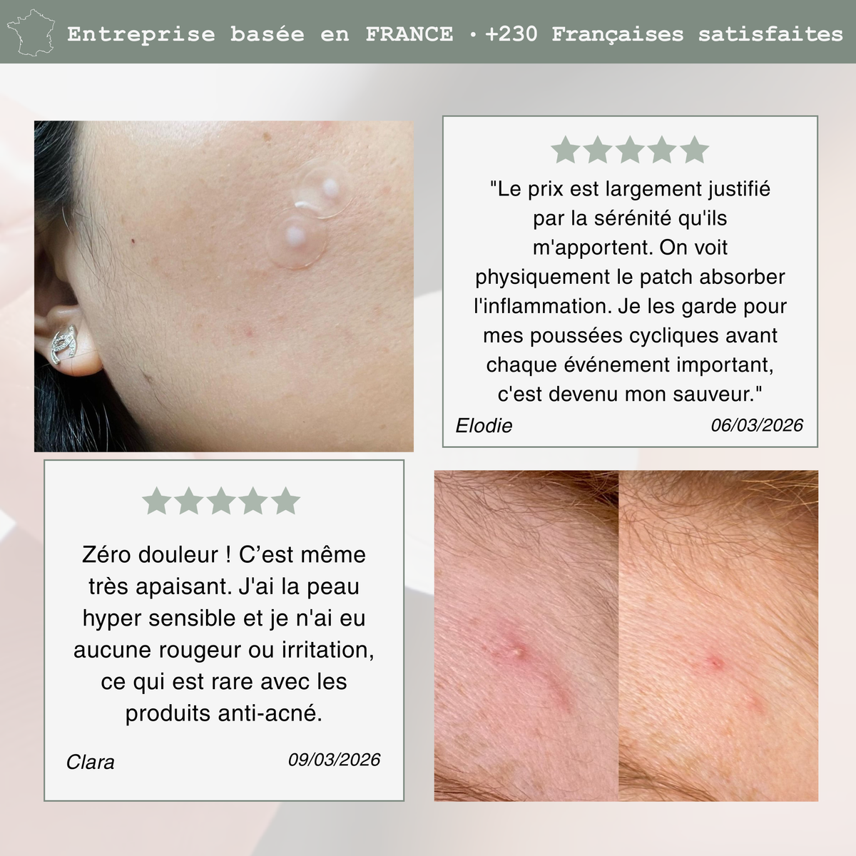 Soin Ciblé Acné Hormonale – Patchs Invisibles