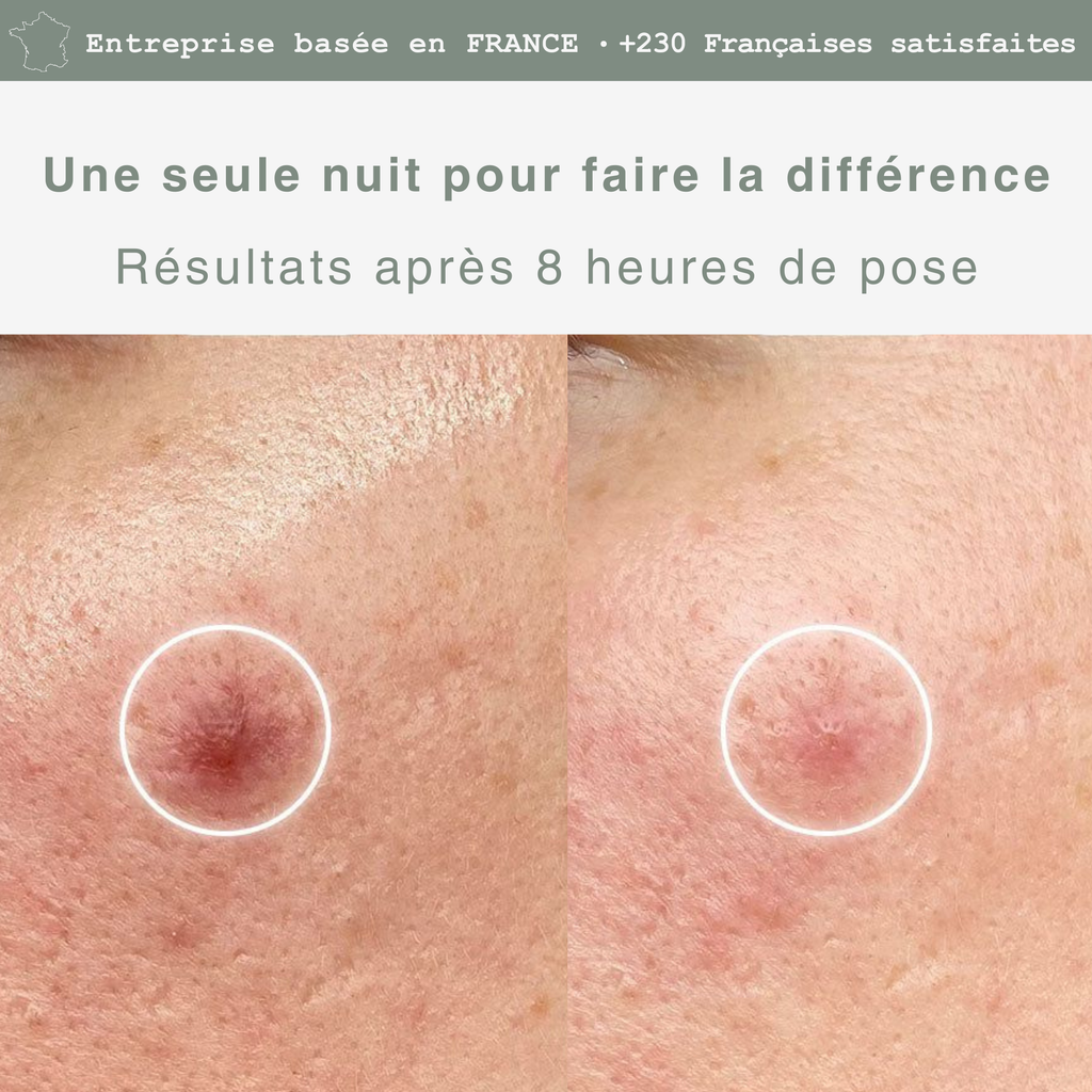 Soin Ciblé Acné Hormonale – Patchs Invisibles